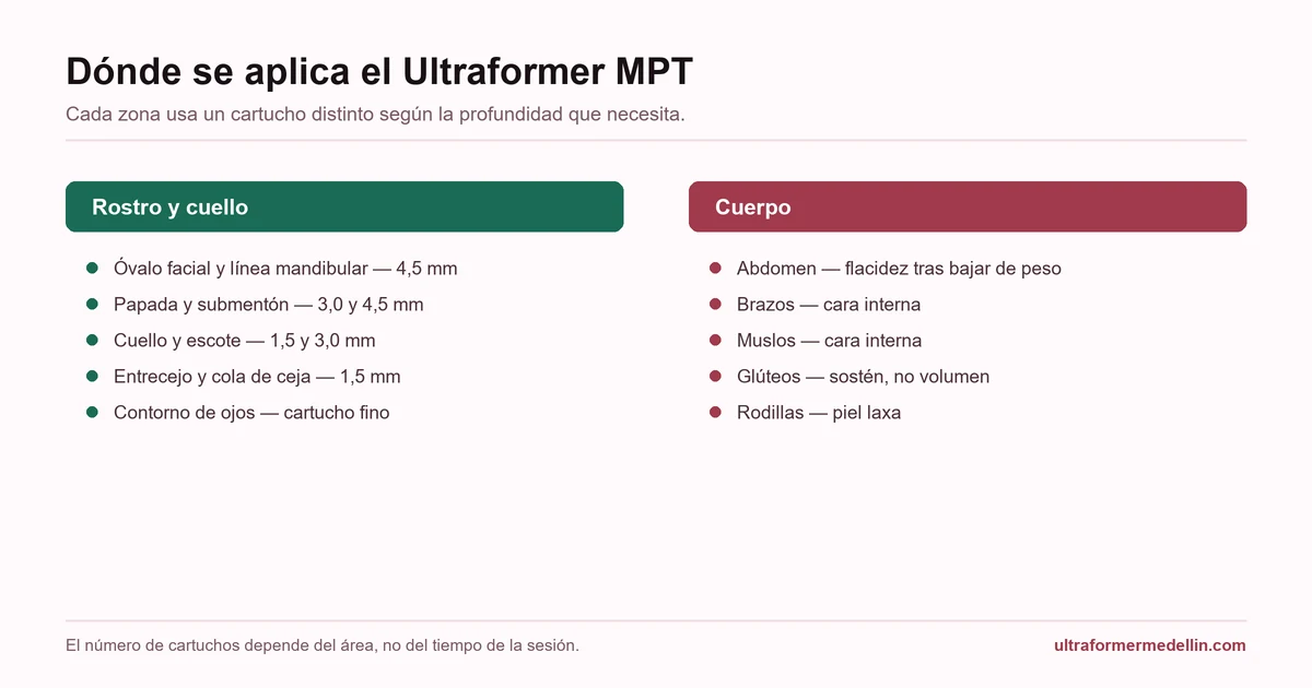 Áreas de tratamiento del Ultraformer MPT en rostro, cuello y cuerpo, con la profundidad de cartucho que usa cada zona