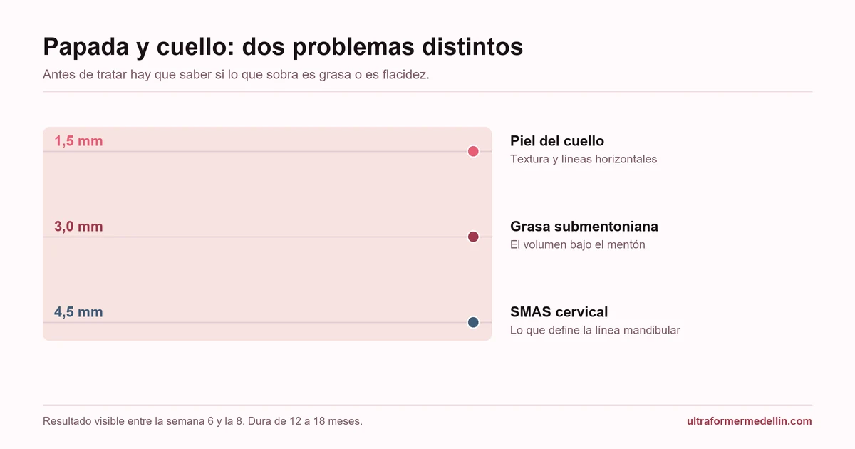 Profundidades del Ultraformer MPT en papada y cuello: 1,5 mm en la piel, 3,0 mm en la grasa submentoniana y 4,5 mm en el SMAS cervical