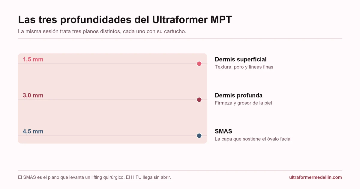 Corte de la piel con las tres profundidades del Ultraformer MPT: 1,5 mm en dermis superficial, 3,0 mm en dermis profunda y 4,5 mm en el SMAS
