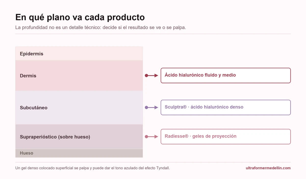 Esquema de las capas de la piel indicando a qué profundidad se coloca cada tipo de relleno: ácido hialurónico en dermis, Sculptra en subcutáneo y Radiesse en plano profundo