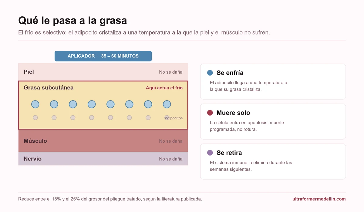 Esquema de las capas de la piel durante una sesión de criolipólisis: el aplicador enfría la grasa subcutánea sin dañar piel, músculo ni nervio