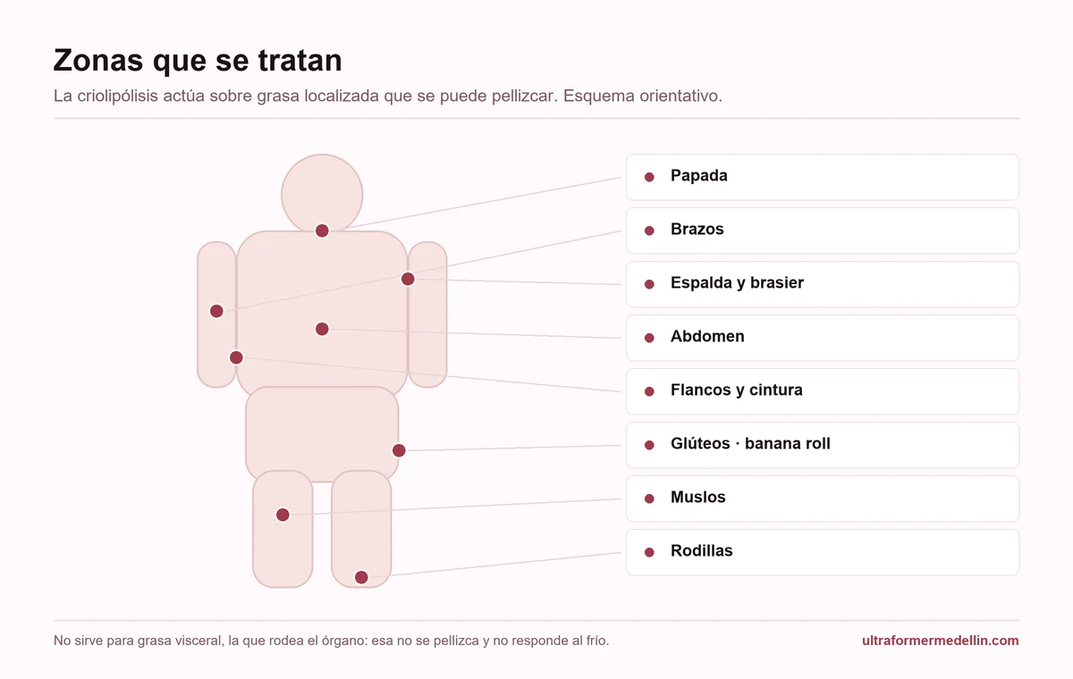 Silueta con las zonas donde se aplica criolipólisis: papada, brazos, espalda y brasier, abdomen, flancos y cintura, glúteos, muslos y rodillas