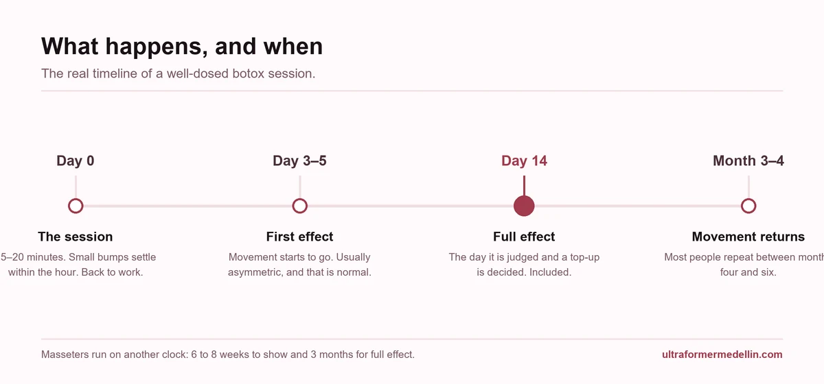 Botox timeline: day 0 the session, days 3 to 5 first effect, day 14 full effect and review, months 3 to 4 movement returns