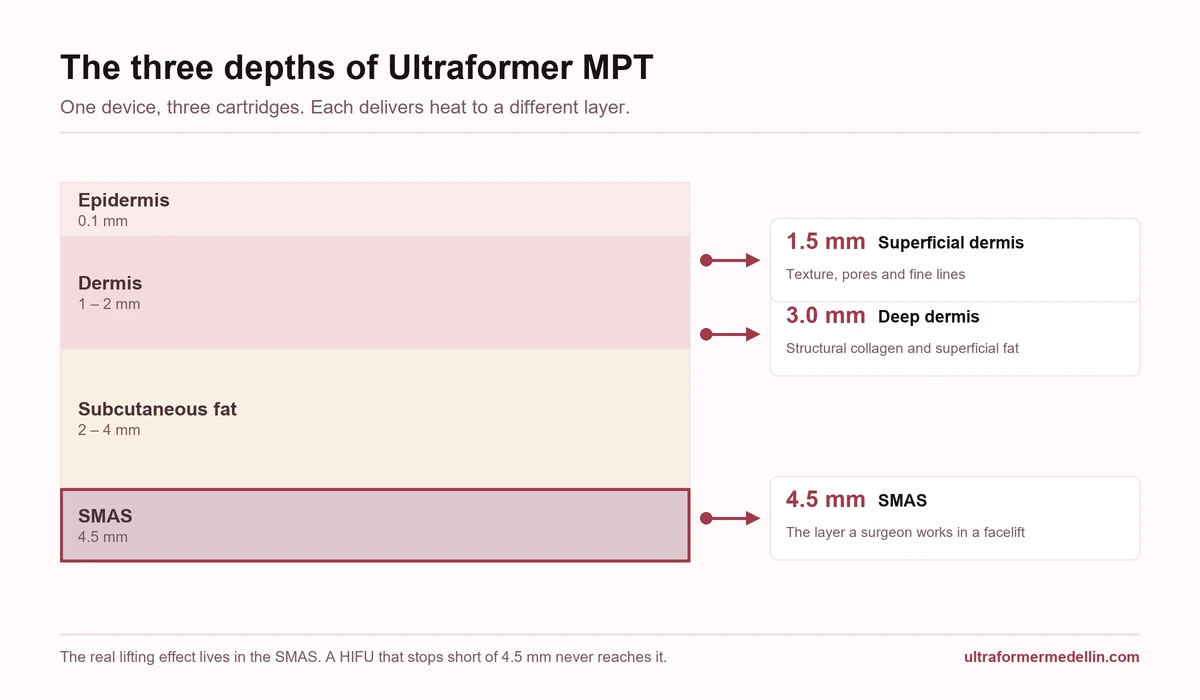 Diagram of the skin layers with the three Ultraformer MPT depths: 1.5 mm superficial dermis, 3.0 mm deep dermis and 4.5 mm SMAS