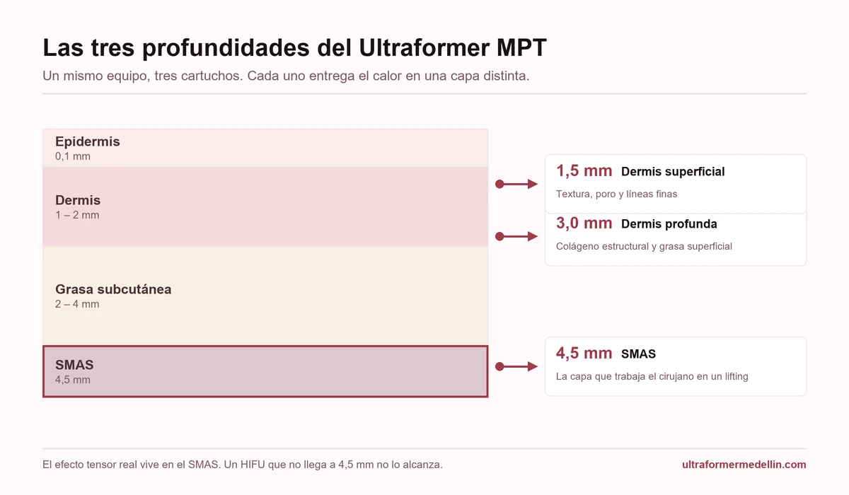 Esquema de las capas de la piel con las tres profundidades del Ultraformer MPT: 1,5 mm en dermis superficial, 3,0 mm en dermis profunda y 4,5 mm en el SMAS