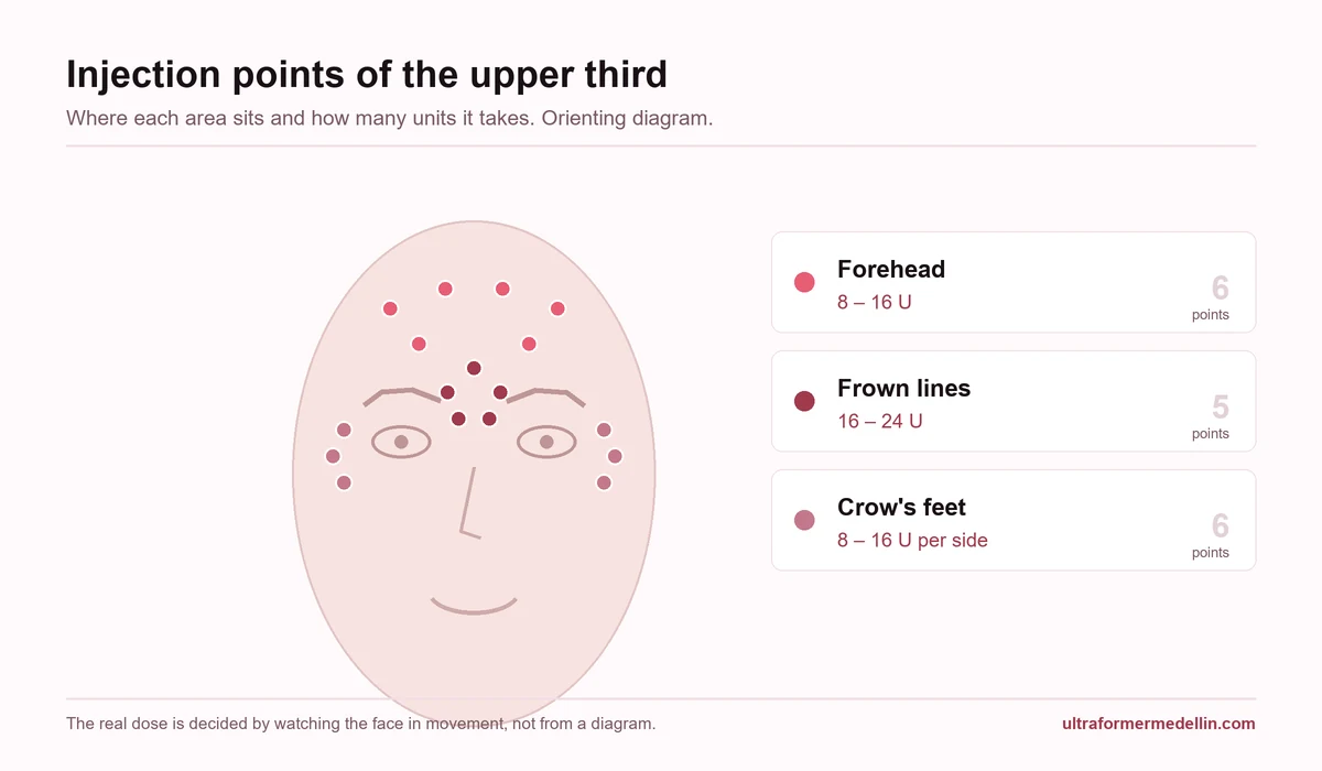 Facial diagram with the injection points of the upper third: 6 points on the forehead, 5 on the glabella and 6 on the crow’s feet