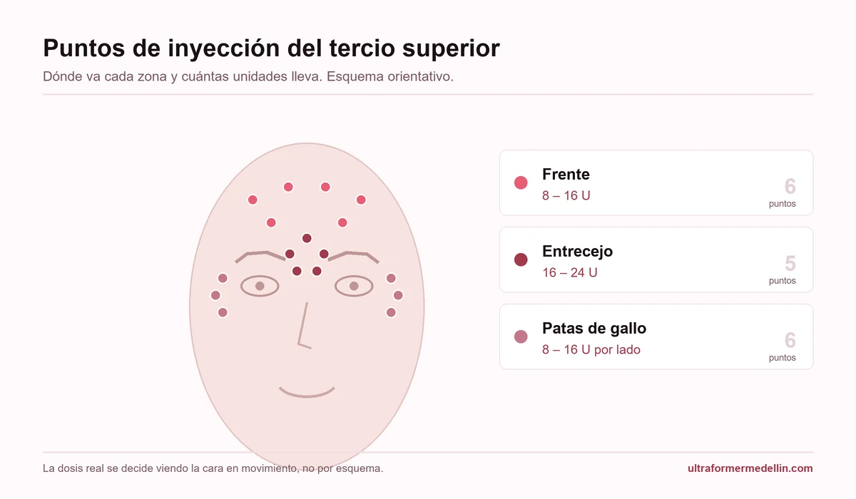 Esquema facial con los puntos de inyección del tercio superior: 6 puntos en frente, 5 en entrecejo y 6 en patas de gallo