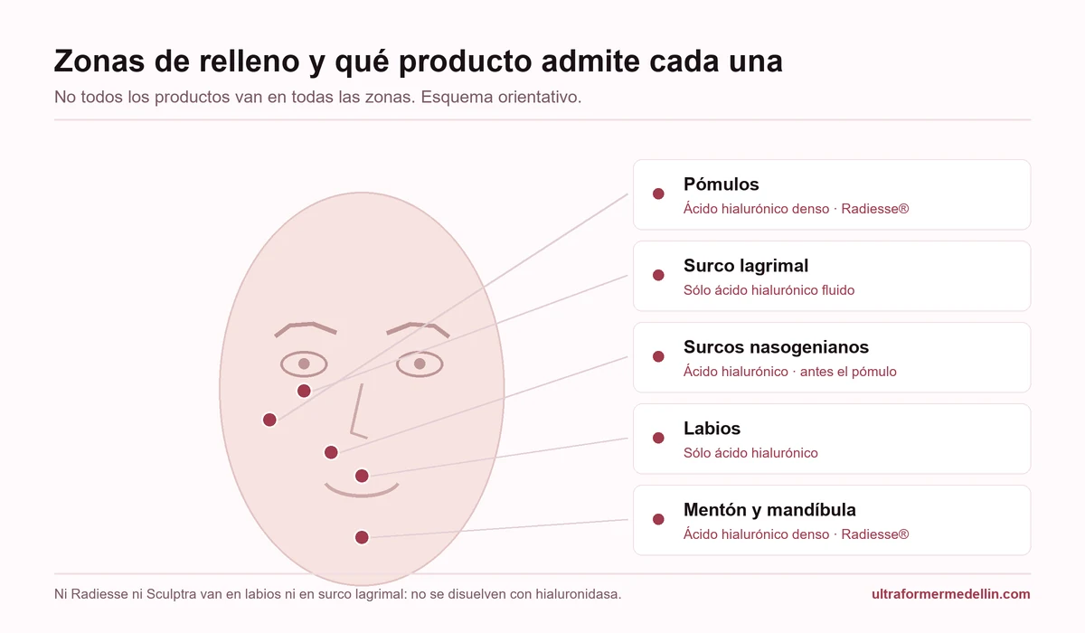 Mapa facial con las zonas donde se aplica relleno: labios, surco lagrimal, pómulos, surcos nasogenianos, mentón y mandíbula