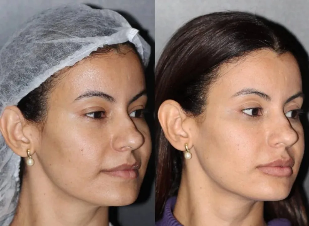 Antes y después HIFU facial Medellín — óvalo facial