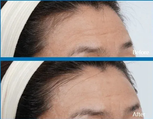 Antes y después HIFU frente Medellín
