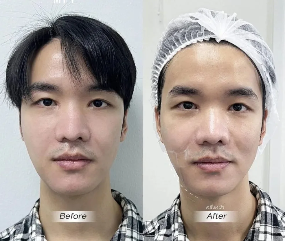 Antes y después rejuvenecimiento facial sin cirugía Medellín