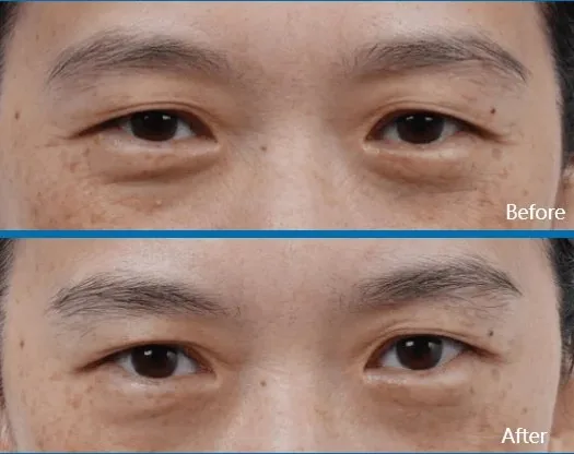 Antes y después rejuvenecimiento contorno ojos Medellín