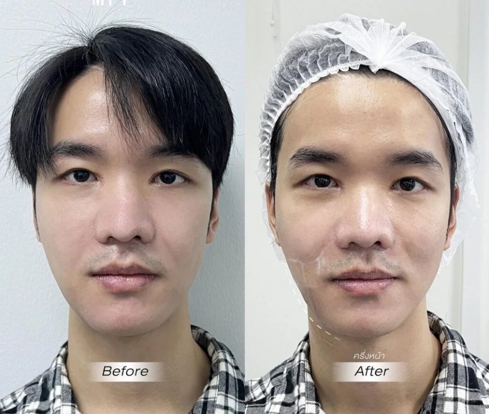Resultado Ultraformer MPT antes y después — Contorno facial Medellín