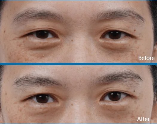 Resultado Ultraformer MPT antes y después — Contorno de ojos Medellín